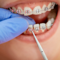 Get An Idea About Different Types of Braces Useful for All Age Groups